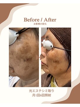 リフトアップ、脱毛