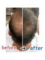 ブルーフィン シセロ(Blue Fin cicero) 頭皮改善!育毛促進ケア!