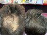 育毛促進・女性専用】純度100%幹細胞上清液＋NMN500mg ￥44000→￥24200