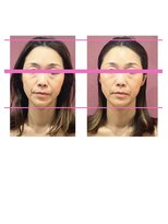 銀座ねむり姫 GINZA east店 ほほ、あご、頭がすっきり!バザルトヘッドスパ&フェイシャル