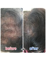 ブルーフィン シセロ(Blue Fin cicero) 頭皮改善!育毛促進ケア!