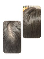 ユーフォルムギンザ(y-Forme Ginza)&nbsp;話題のトキカタ♪頭頂部編