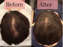 髪や頭皮の状態に合わせた育毛促進メニュー【強髪】ヒト幹細胞培養液を使用した最新のエイジングケアです。