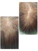 ユーフォルムギンザ(y-Forme Ginza)&nbsp;話題のトキカタ♪頭頂部編