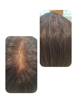 ユーフォルムギンザ(y-Forme Ginza) 話題のトキカタ♪頭頂部編