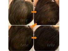 ヘッドスパ専門店 テテ(tete)の雰囲気（人気のモナリ＋幹細胞導入♪頭皮を柔らかくして導入していきます）