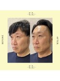 エクソリフト