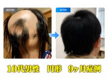 グロウの雰囲気（10代男性　円形　9ヶ月症例）