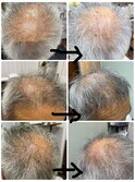 頭皮治療/頭皮改善/頭皮悩み/三島市で頭皮改善に特化した美容師