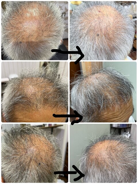 頭皮治療/頭皮改善/頭皮悩み/三島市で頭皮改善に特化した美容師