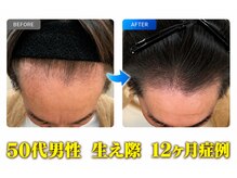 グロウの雰囲気（50代男性　生え際　12ヶ月症例）