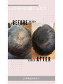 ビーヘアー 近鉄八尾店(Bee.hair)&nbsp;Litでフサフサヘアーに頭皮改善へ