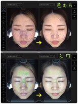 アート(Art)&nbsp;肌診断で肌質改善♪