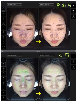 アート(Art) 肌診断で肌質改善♪