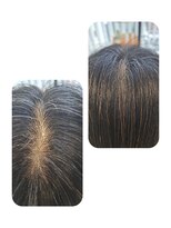 ユーフォルムギンザ(y-Forme Ginza)&nbsp;話題のトキカタ♪頭頂部編