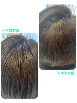 ユーフォルムギンザ(y-Forme Ginza) 話題のトキカタ♪頭頂部編