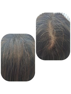 ユーフォルムギンザ(y-Forme Ginza) 話題のトキカタ♪頭頂部編