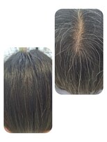 ユーフォルムギンザ(y-Forme Ginza)&nbsp;話題のトキカタ♪頭頂部編