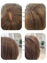 ユーフォルムギンザ(y-Forme Ginza)&nbsp;話題のトキカタ♪頭頂部編