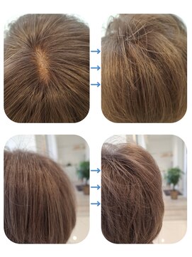 ユーフォルムギンザ(y-Forme Ginza) 話題のトキカタ♪頭頂部編