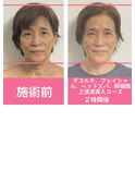 しらゆきコース