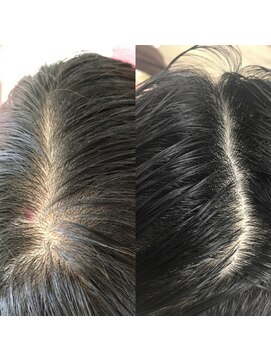 ルーミールーム(RoomieRoom) 頭皮改善／ビフォア＆アフター