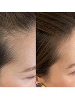 シール(Syl)&nbsp;プロセルセラピーズ 症例