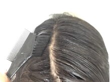 ◇その7◇頭皮が弱い