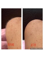 アコ(aco)&nbsp;シェービングですっきり