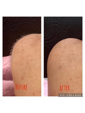 アコ(aco) シェービングですっきり