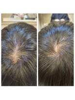 モニカ 横須賀中央店(Monica)&nbsp;ヒト幹細胞/30代40代