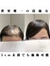 【1日1人限定・世界唯一の神業、特殊技術】自毛が5cm未満だけど増やしたい方
