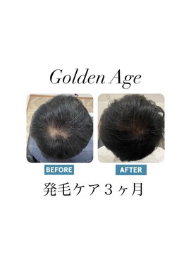 ゴールデンエイジ(Golden Age) 【発 毛 ケ ア 3ヶ月】Before&After