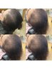 【ヒト幹細胞導入×頭皮ケア体験】２２，０００円→６，６００円