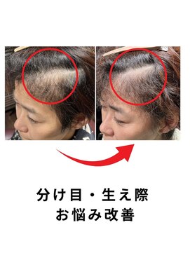 キヌ 銀座(KINU) 育毛促進ケア　月１回　計４回