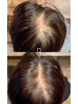 ライムヘアービューティフィー(Lime hair beautify) ヒト幹細胞使用【強髪】育毛促進 30代、40代、50代