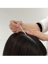 頭皮に幹細胞培養液を直接導入