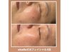 【シミケア】最新光フェイシャル