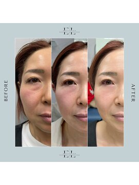 ラナヘアー(lana hair) エクソリフト