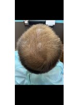 エボノスヘアー エボノスヘアー&nbsp;半年でこの成果