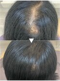 プレミアム育毛促進美髪コース6ヶ月後の効果