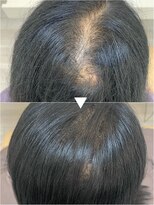 レヴィア(revia)&nbsp;プレミアム育毛促進美髪コース6ヶ月後の効果