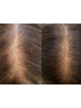 【髪質改善専門サロン】京都唯一の幹細胞100%上清液使用し、特殊機械で頭皮の奧に届ける育毛促進メニュー