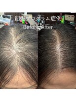 ハーティー(Hearty) トップボリューム改善