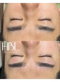 HBL（ハリウッドブロウリフト）