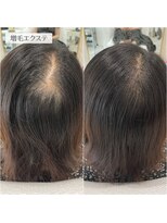 エクステサロンエム(EXTE SALON M) 増毛エクステ（つむじ）