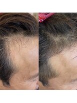 シール(Syl)&nbsp;プロセルセラピーズ 症例