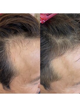 シール(Syl) プロセルセラピーズ 症例