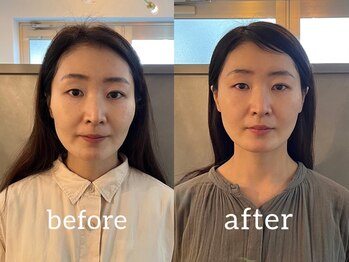 カミベヤ(KAMIBEYA)の写真/フェイスポインターを使った頸肩ほぐし付きメニュー始めました♪