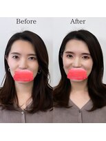 レトア(Letoa)&nbsp;ビフォーアフター